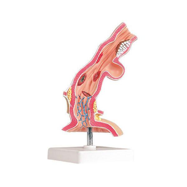 Pathological Model Of Esophagus